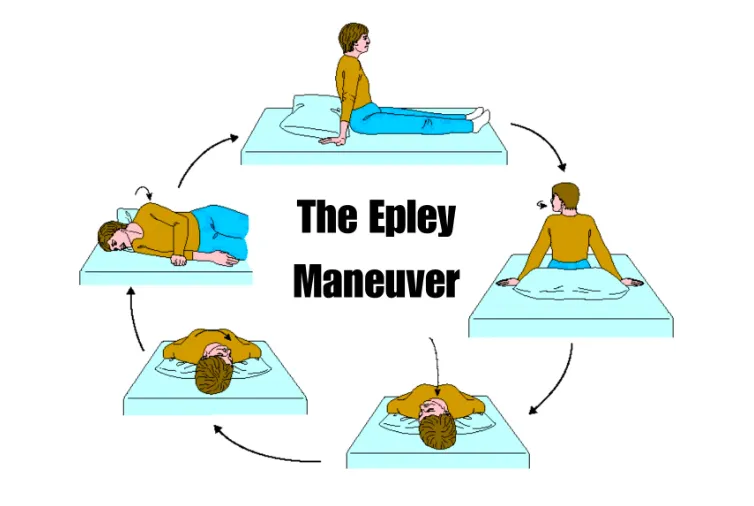 Epley's Maneuver & Vertigo